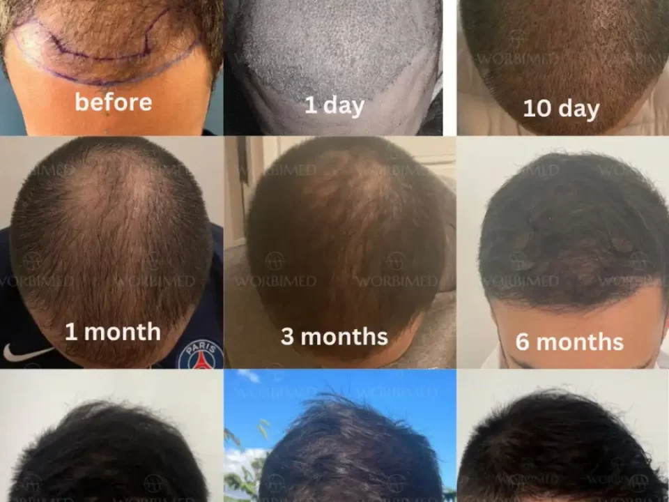 Hair Transplant Timeline Progress