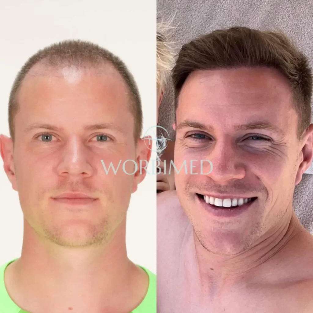 Ter Stegen Hair Transplant l Before and After