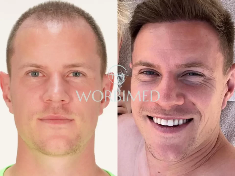 Ter Stegen hair transplant