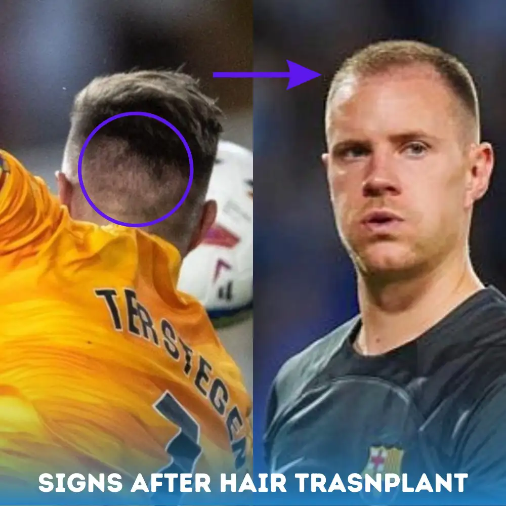 Ter Stegen hair transplant signs