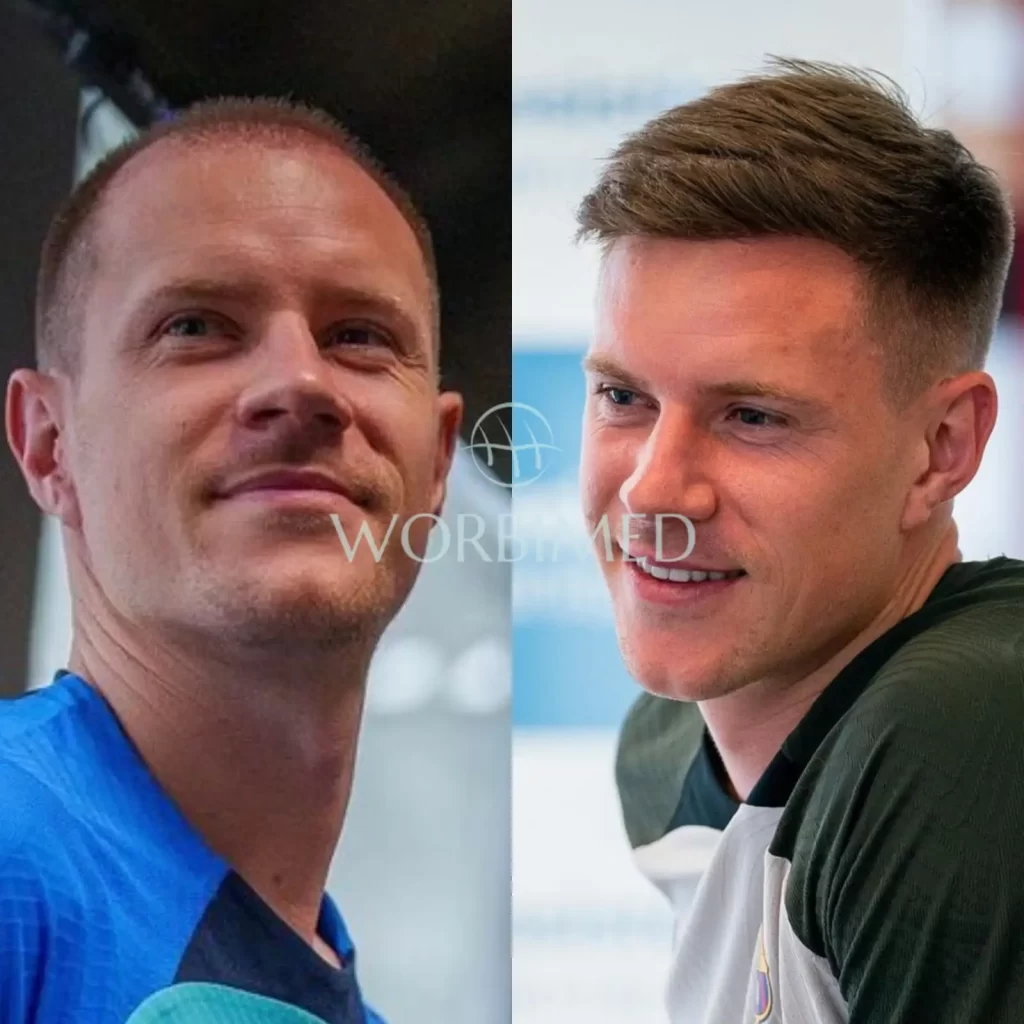 Ter Stegen's hair transplant