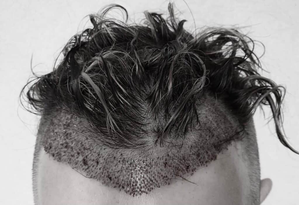 Unshaven hair transplant 