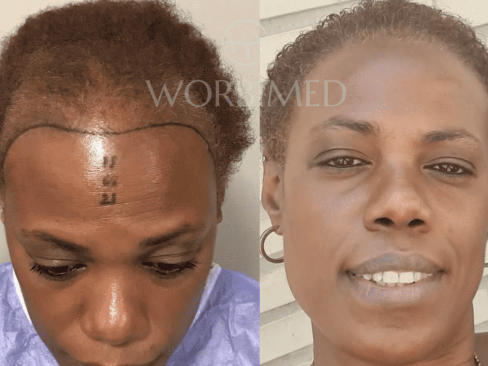 Hair Transplant for black women