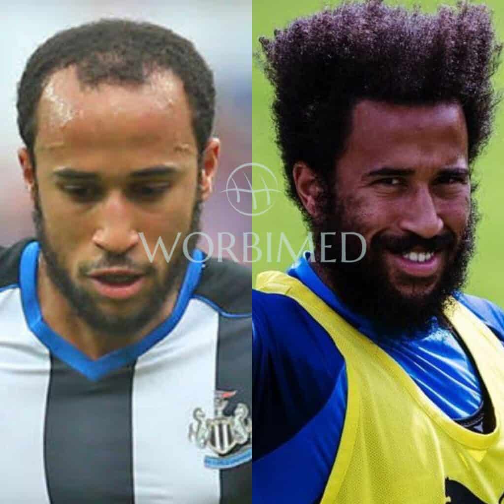 Andros Townsend hair transplant before and after