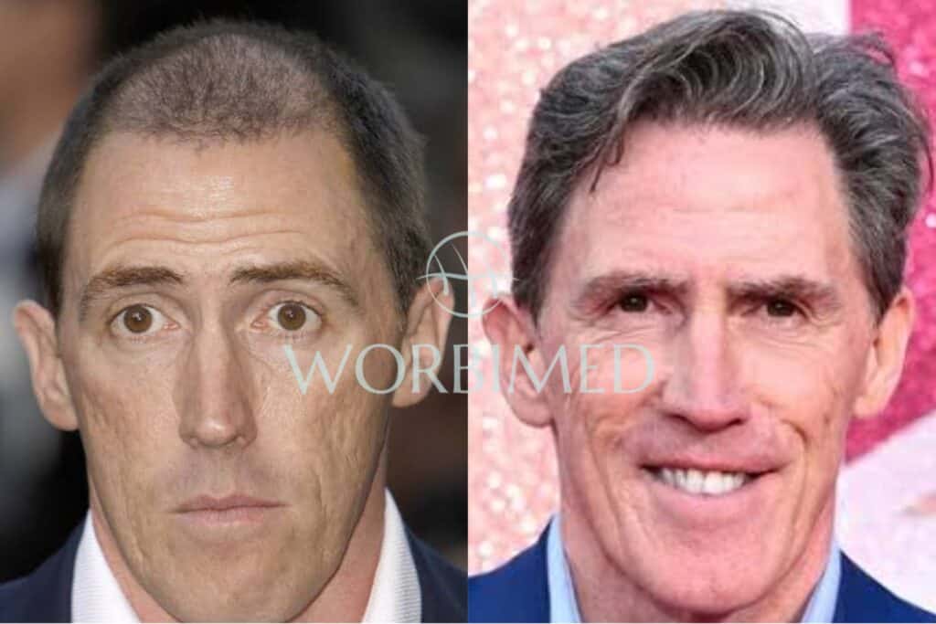 Rob Brydon before and after