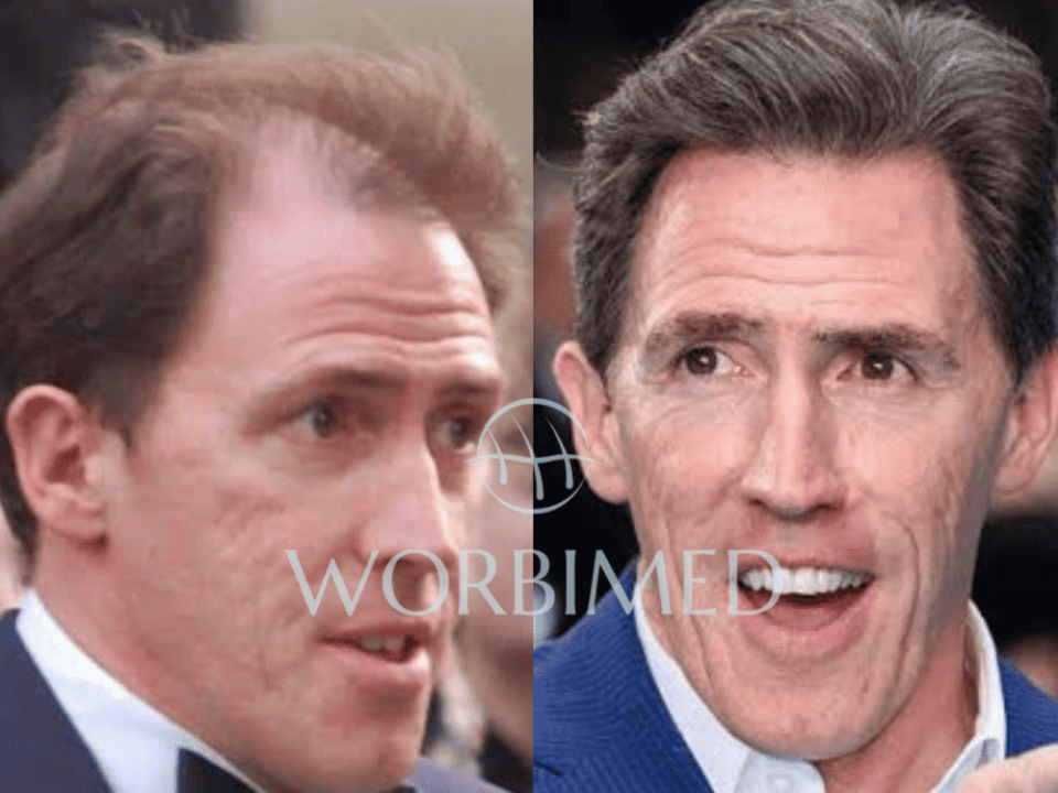 Rob Brydon hair transplant