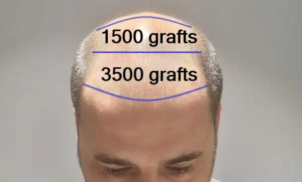 5000 saç grefti ne kadar alanı kapatabilir