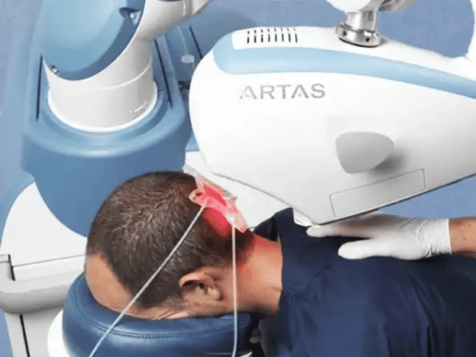 ARTAS robotic hair transplant