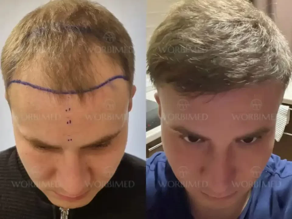 Hair transplant in Birmingham