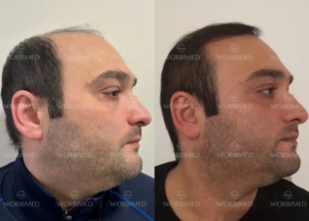 How much does a hair transplant cost in Birmingham