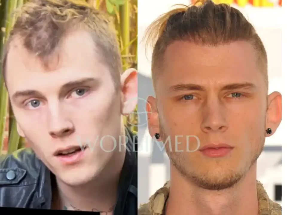 Machine Gun Kelly Hair Transplant