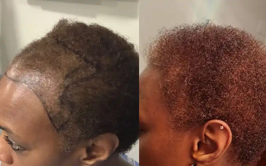 Afro-women-hair-transplant-result