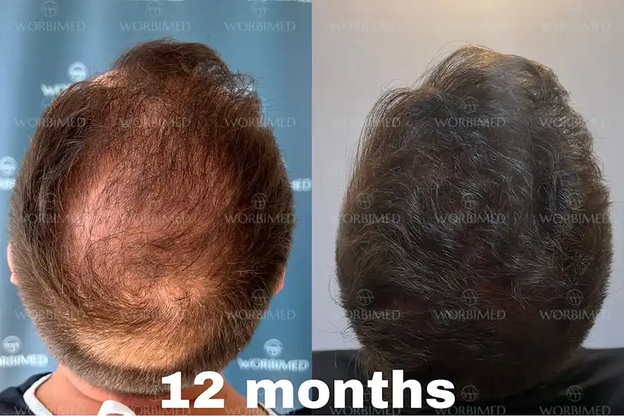 Crown hair transplant 12 months