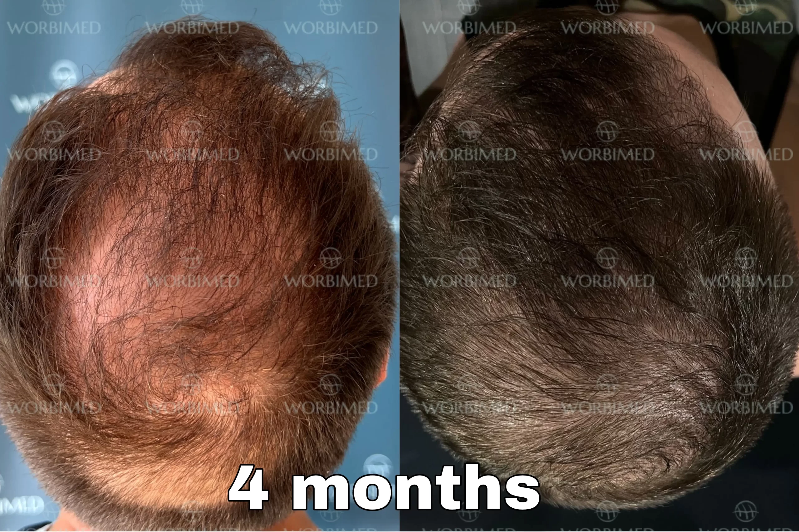 Crown hair transplant 4 months