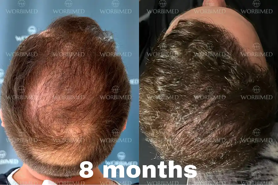 crown hair transplant 8 months