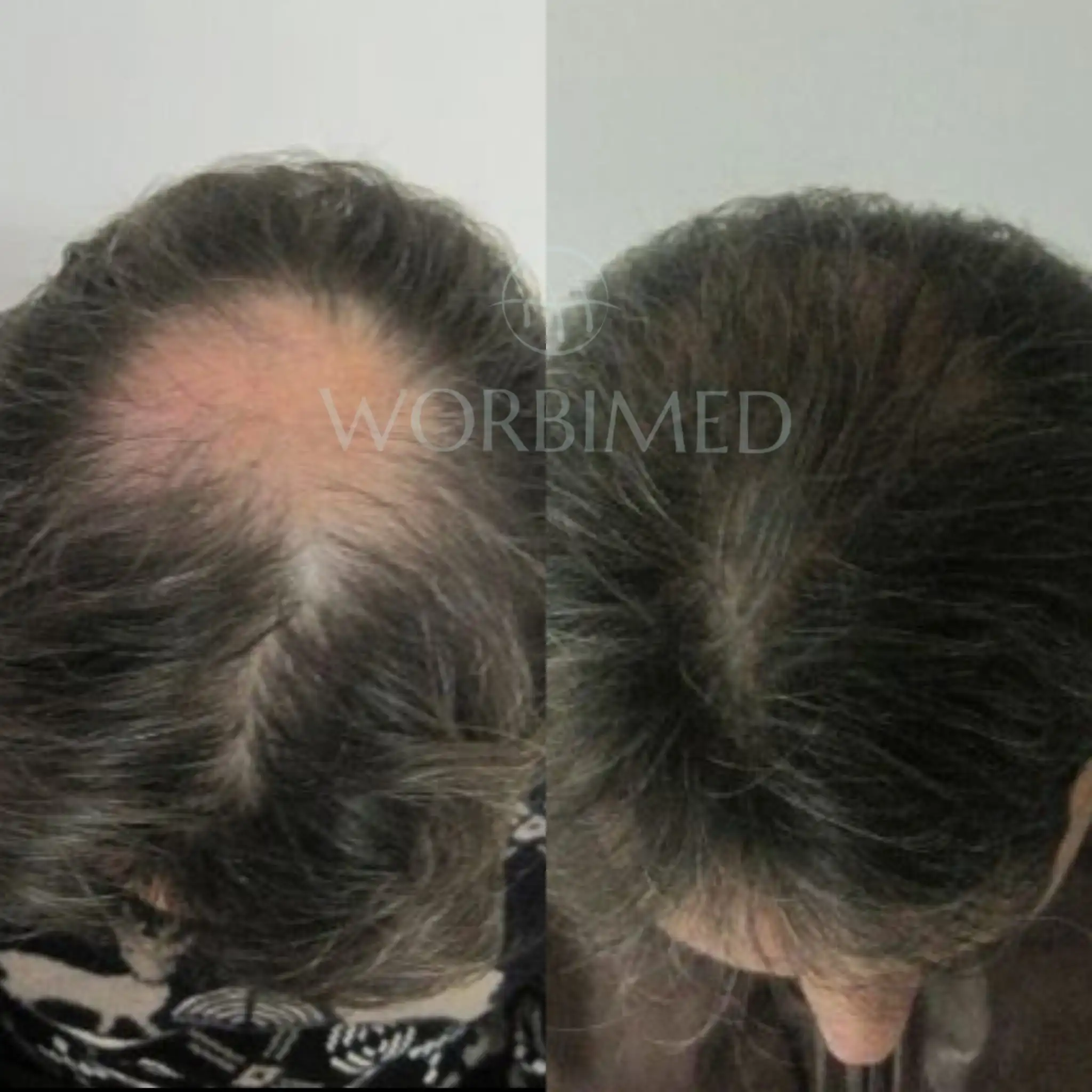 Crown hair transplant before and after