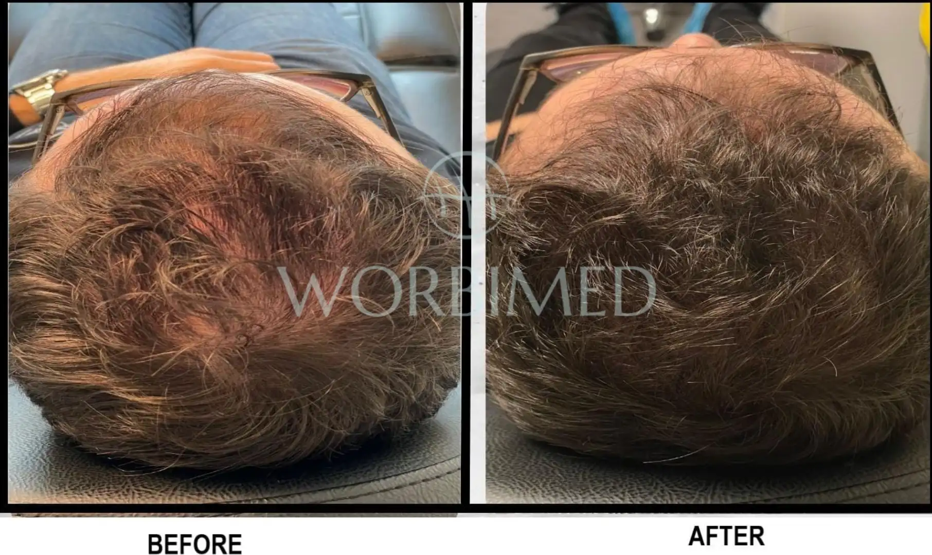 Crown hair transplant result