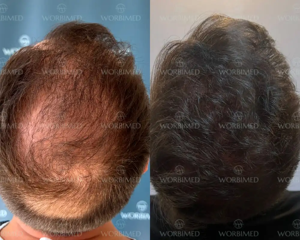 Crown hair transplant