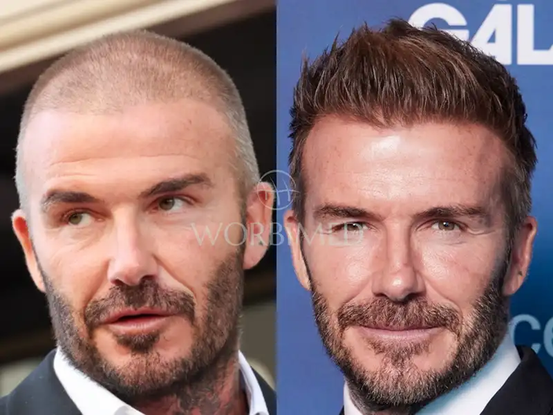 David Beckham Before And After Buzz Cut David Beckham Before And After Buzz Cut