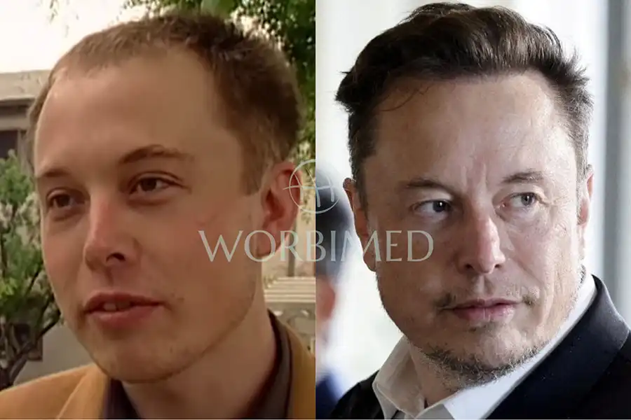 Elon Musk Hair Transplant l Before and After