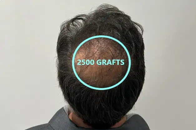 How many grafts are needed for a full crown