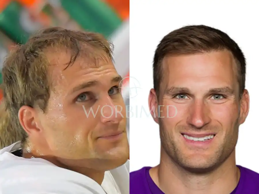 Kirk Cousins hair transplant before and after
