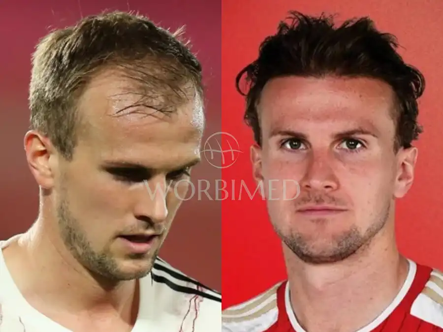 Rob Holding before hair transplant