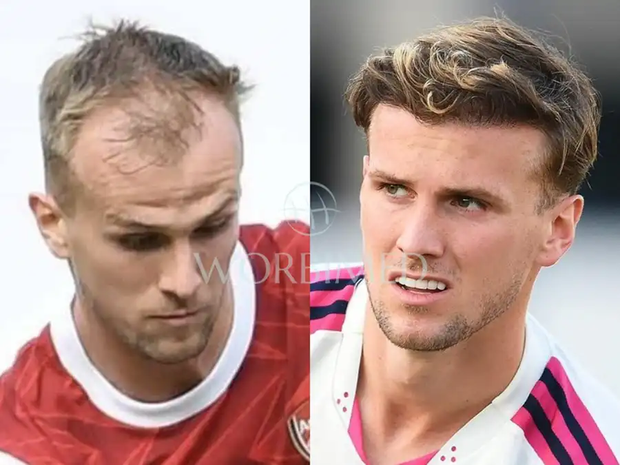 Rob Holding hair transplant befor and after