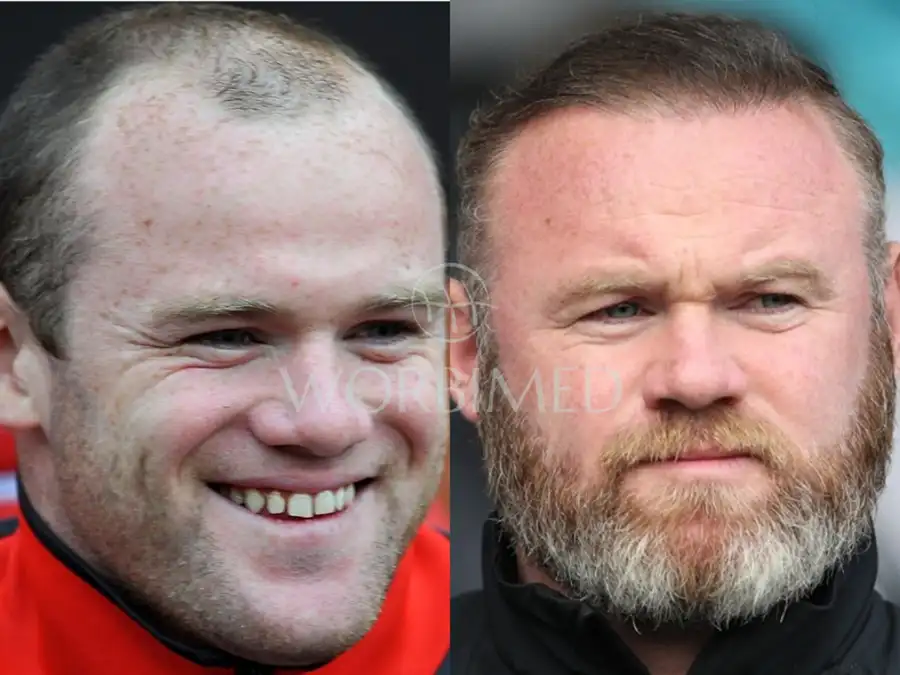 Rooney hair transplant