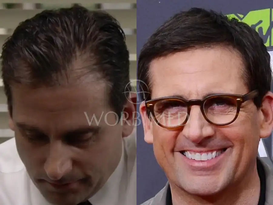 Steve Carell Hair Transplant L Before And After