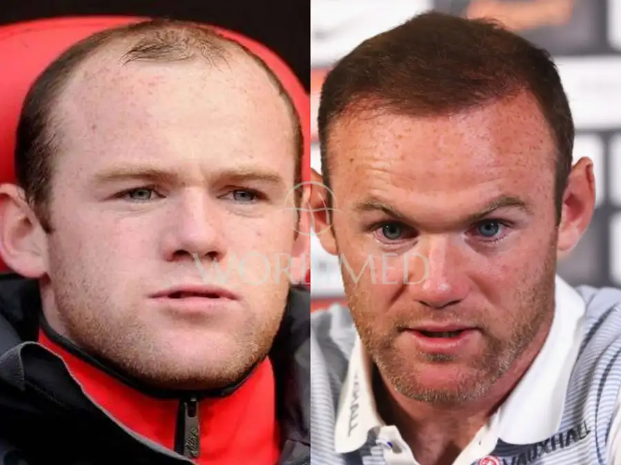 Wayne Rooney before and after hair transplant