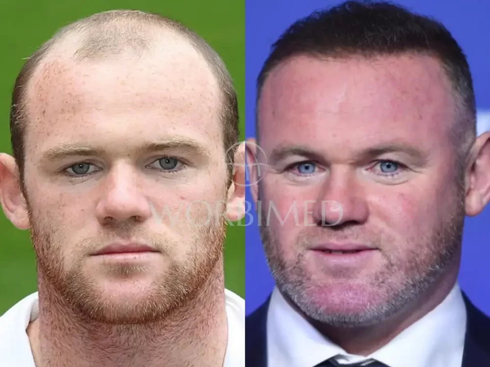 Tristan Tate Hair Transplant