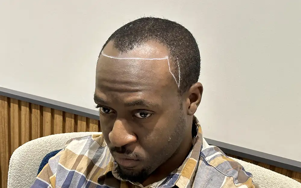 african-american-hair-transplant