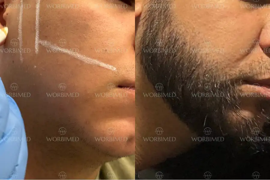 beard-transplant-before-and-after