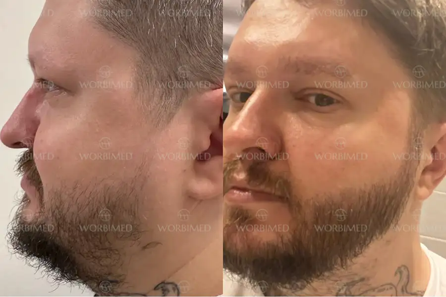 beard-transplant-results