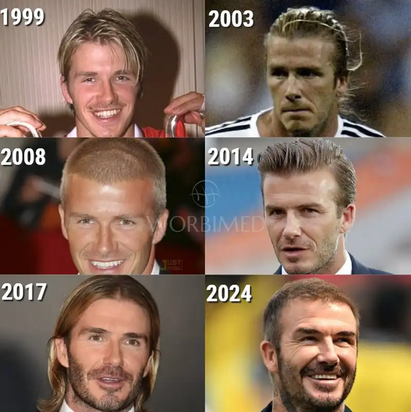 David Beckham Hair Transplant Story | The Shocking Truth