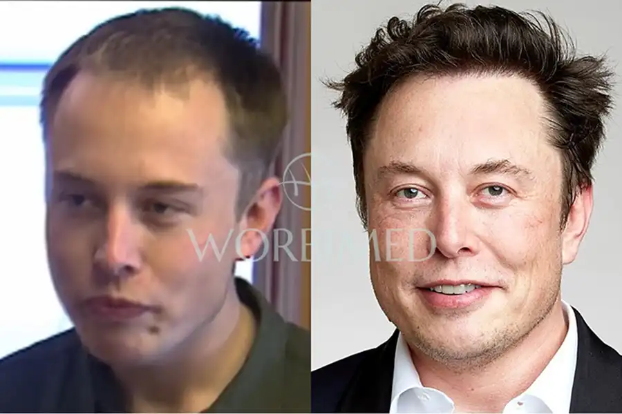 Elon Musk Hair Transplant l Before and After