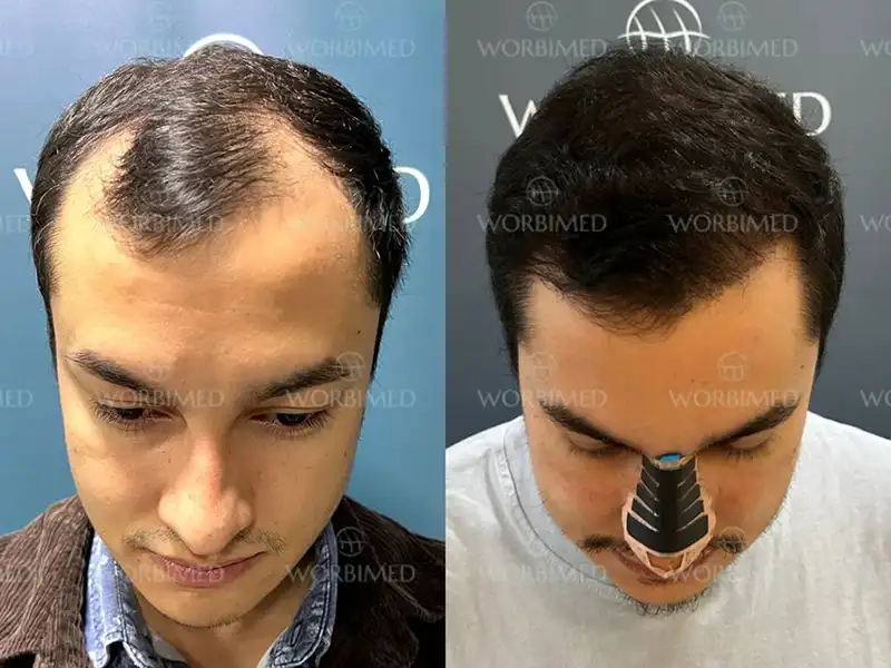 fue hair transplant before and after