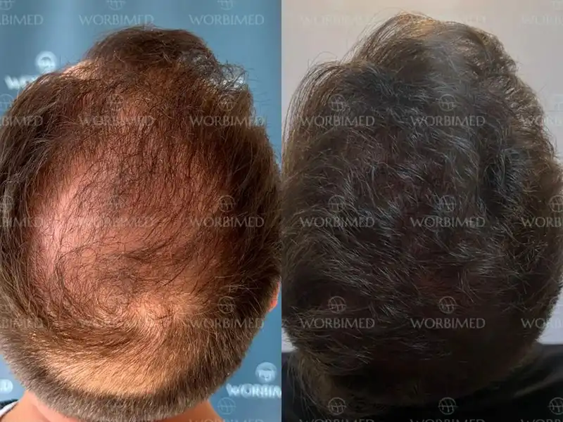 FUE hair transplant after 10 years
