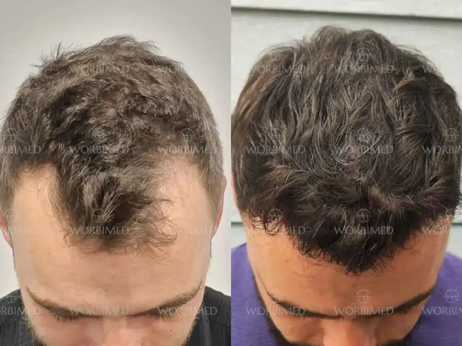 hair transplant isntabul before and after