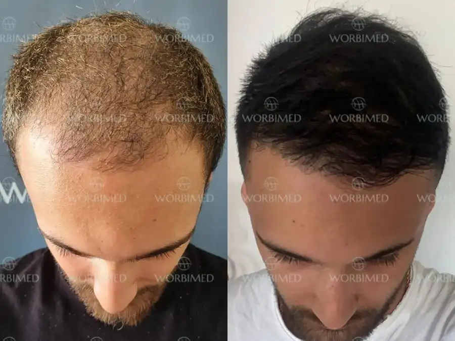 Hair transplant in Istanbul before and after results