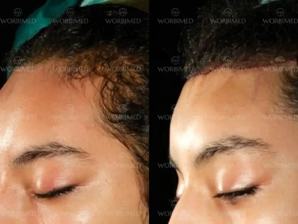 Forehead reduction