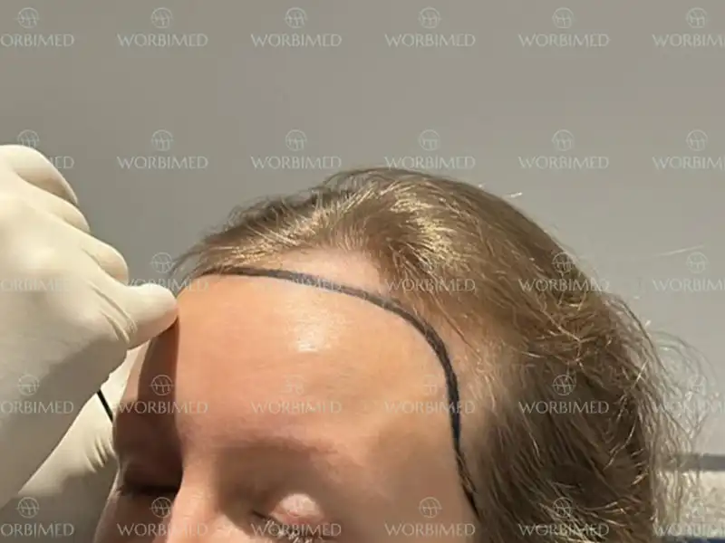 Hairline lowering female
