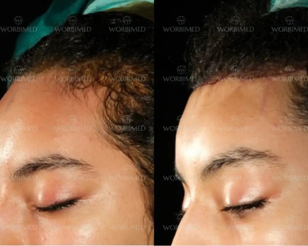 Forehead reduction