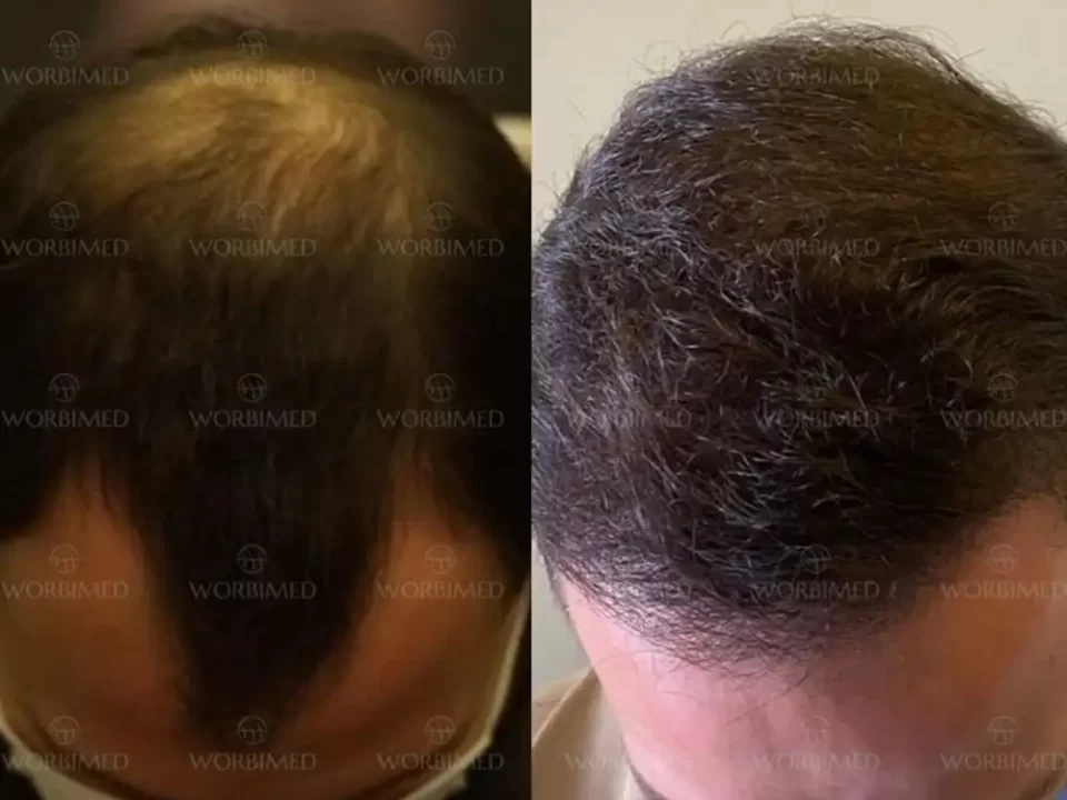 Hair transplant after 10 years