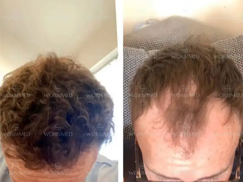 Hair transplant after 10 years

