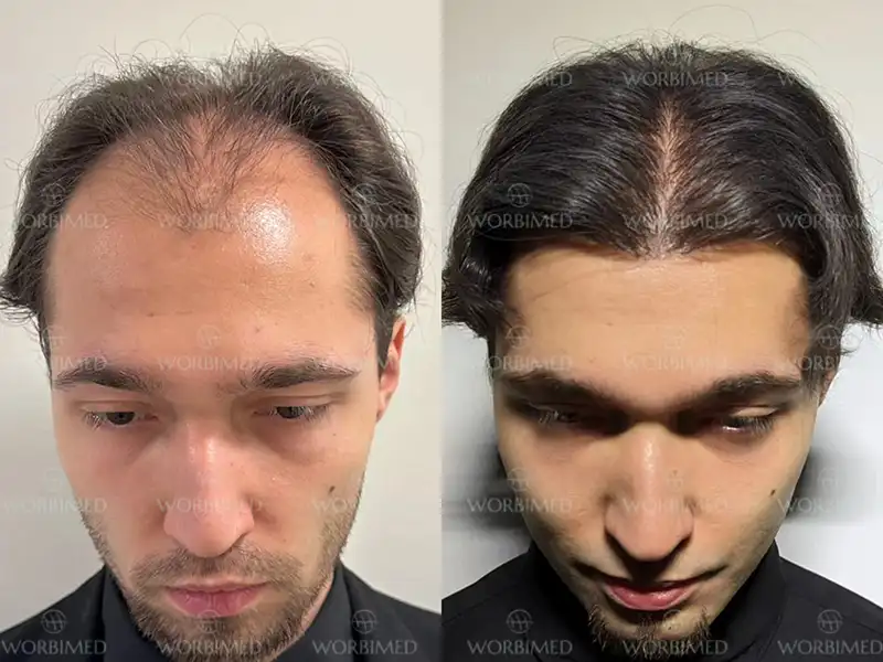 hair transplant in istanbul