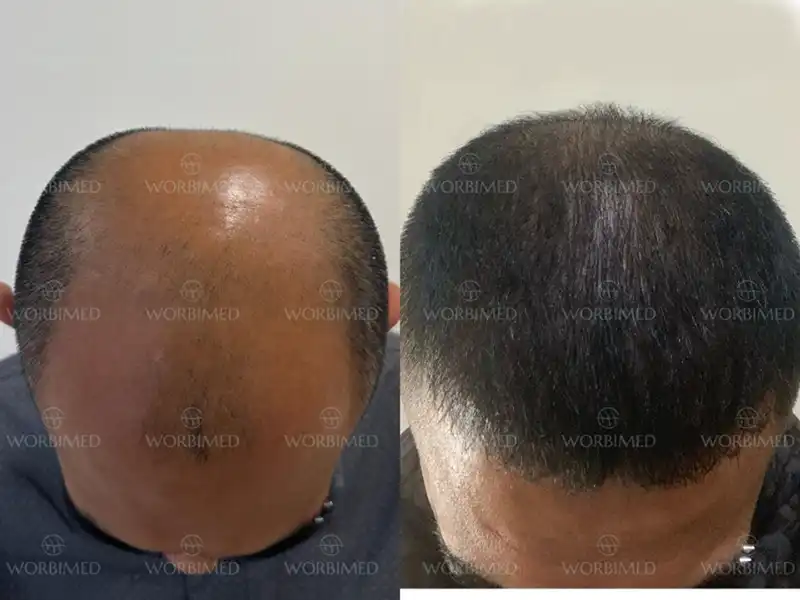 Hair transplant results after 10 years