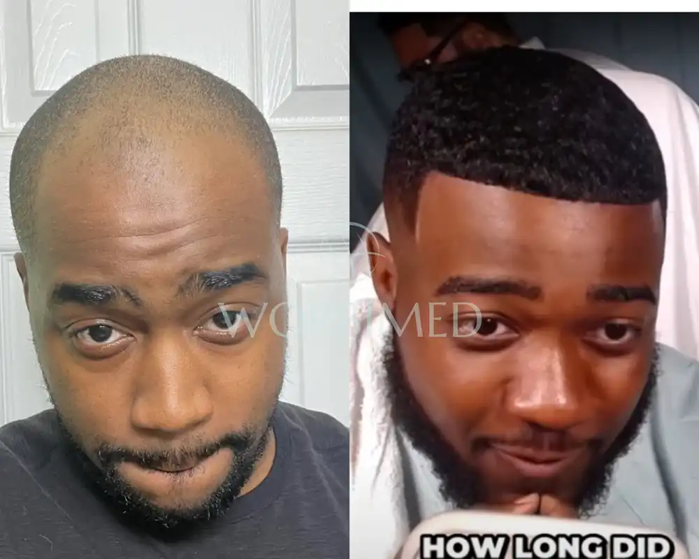 JiDion Hair Transplant JiDion Hairline