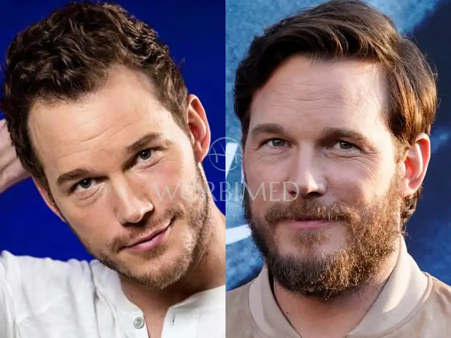 Chris Pratt hair transplant before and after